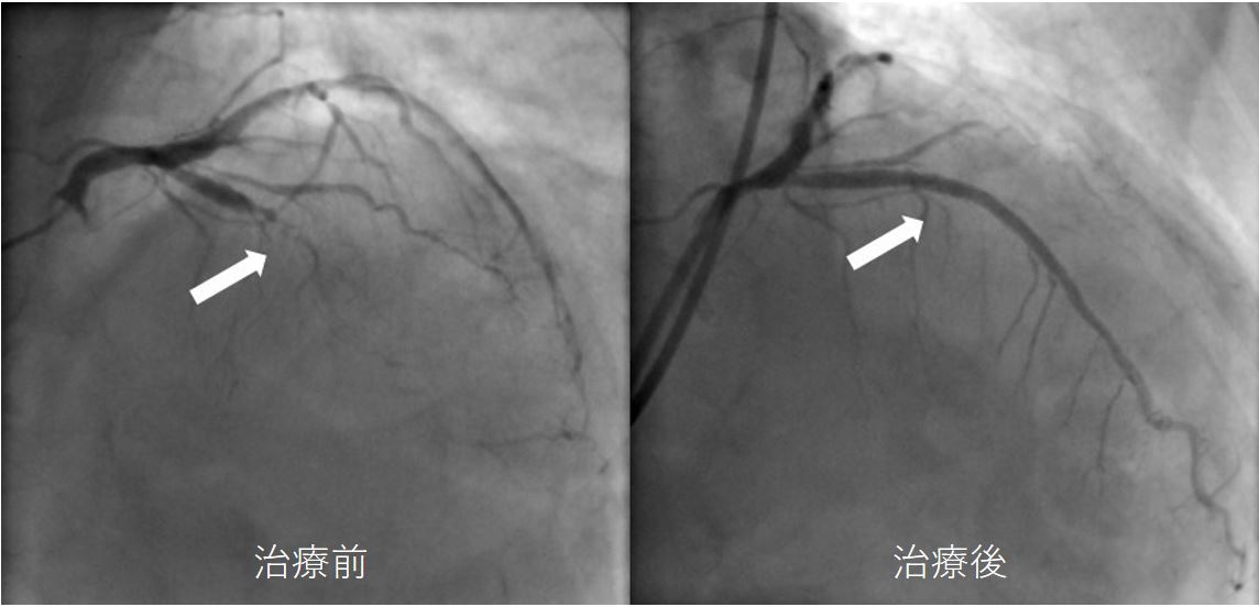 冠動脈治療　治療前と治療後
