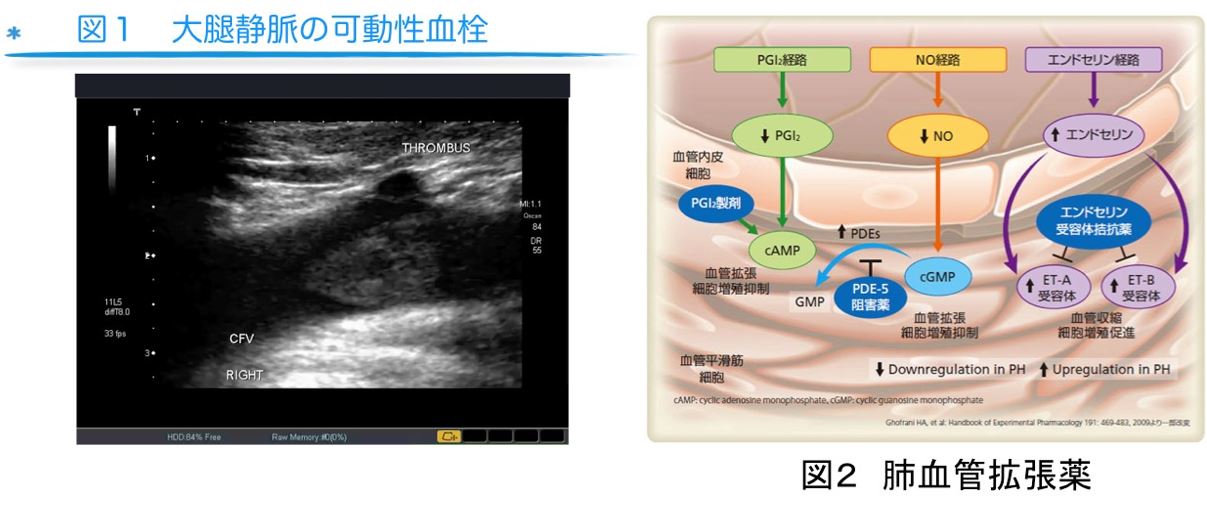 図１　大腿静脈の可能性血栓　図２　肺血管拡張薬