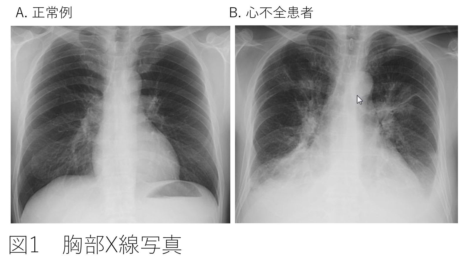 図１胸部Ｘ線写真